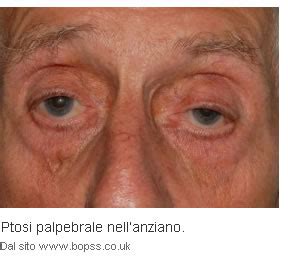 Diagramma che illustra le diverse cause di ptosi palpebrale, con icone che rappresentano invecchiamento, trauma, malattia neurologica, chirurgia.