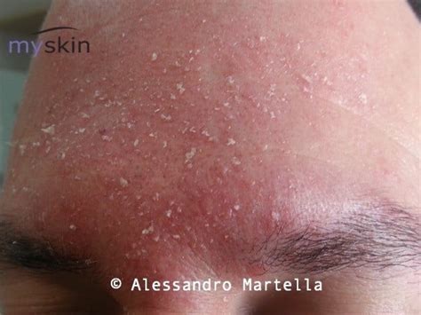 Mappa del viso che evidenzia le aree tipicamente colpite dalla dermatite seborroica