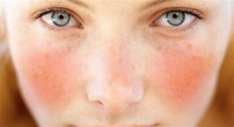 Donna con rossore sul viso