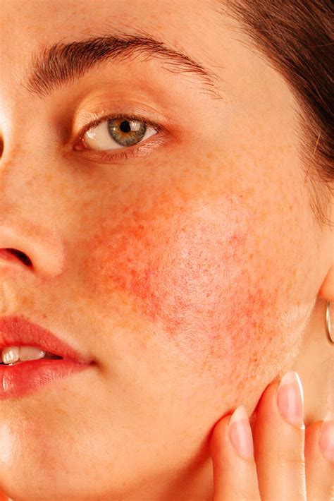 Icone rappresentanti fattori scatenanti della rosacea