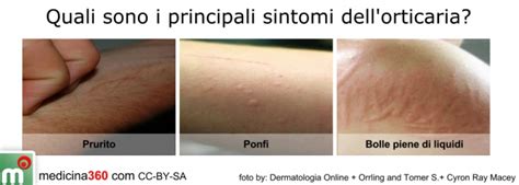 Illustrazione delle diverse tipologie di orticaria fisica