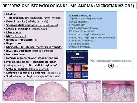 Diagramma comparativo tra crescita orizzontale e verticale del melanoma