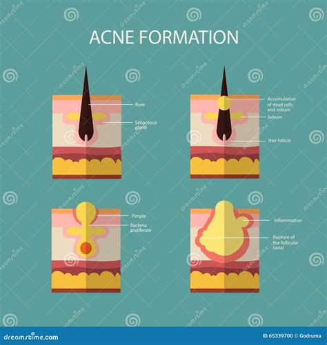 Schema che illustra la formazione di un brufolo