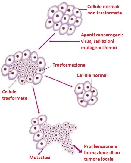 Diagramma che illustra il processo di metastasi ossea, mostrando le cellule tumorali che viaggiano dal tumore primario all'osso