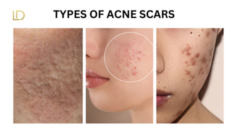 A person's face showing various types of acne scars