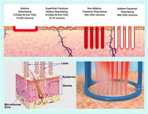 Diagram illustrating the mechanism of an ablative laser resurfacing