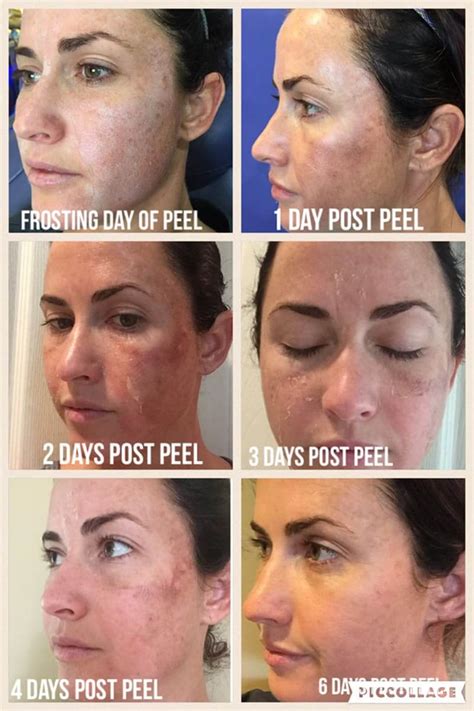 Cronologia degli effetti post-peeling TCA