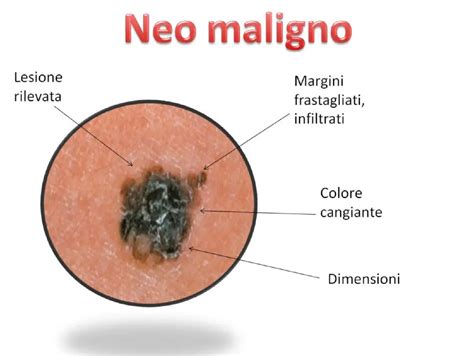 Schema di un neo normale e di un neo sospetto melanoma