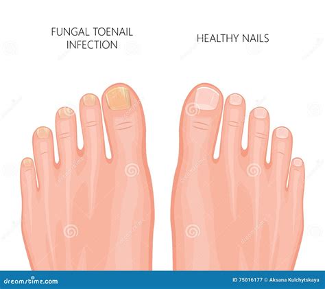 Illustrazione di un'unghia del piede infettata da fungo, con evidenziate le alterazioni di colore e spessore.
