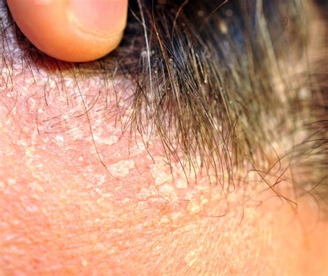 Immagine ravvicinata di squame giallastre tipiche della dermatite seborroica sul cuoio capelluto