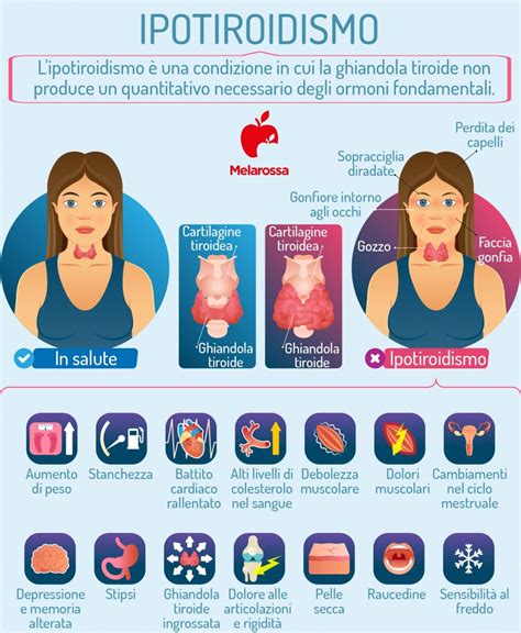Diagramma che illustra i sintomi dell'ipotiroidismo