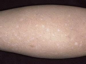 Immagine che mostra chiazze di vitiligine su diverse parti del corpo