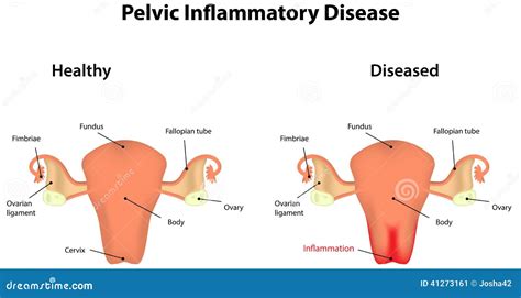 Schema della Malattia Infiammatoria Pelvica (PID)