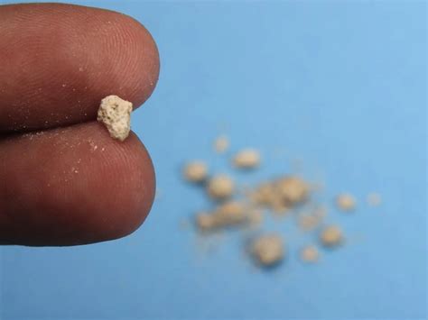 Diagramma di un calcolo renale che ostruisce le vie urinarie