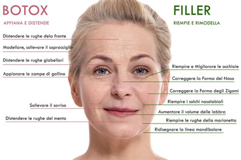 Schema del viso con punti di iniezione per filler e botulino