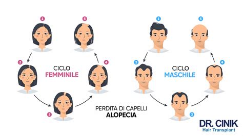 Schema dell'alopecia androgenetica maschile e femminile
