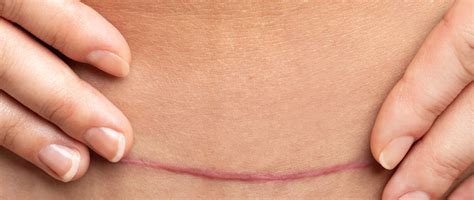 Immagine comparativa di una cicatrice normale e una ipertrofica