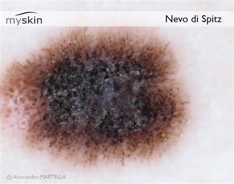 Dermatoscopia di un neo atipico