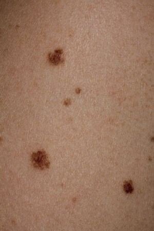 Esempi di nevi atipici con bordi irregolari e colorazione variabile