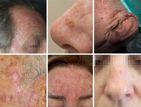 Cheratosi attinica sul viso