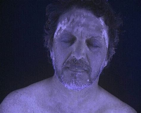 Una lampada di Wood che illumina una macchia di vitiligine sulla pelle