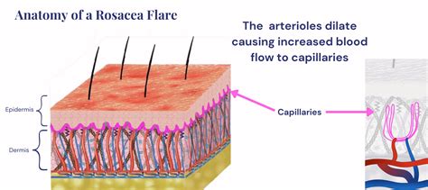 Diagramma che illustra le diverse fasi della rosacea