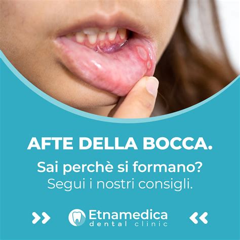 Infografica che elenca i comuni fattori scatenanti della rosacea