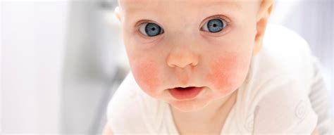 bambino con pelle sensibile