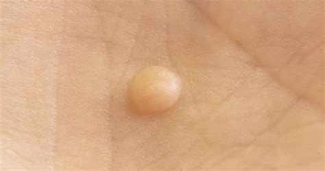 Illlustrazione di verruche genitali nell'area genitale maschile e femminile