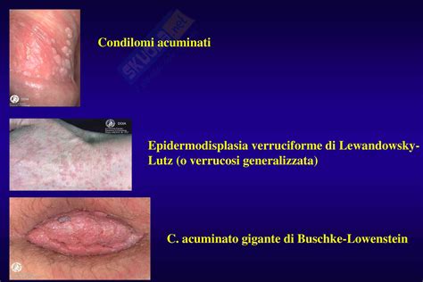 Illustrazione di condilomi acuminati con aspetto a cavolfiore
