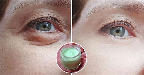 cetriolo per contorno occhi