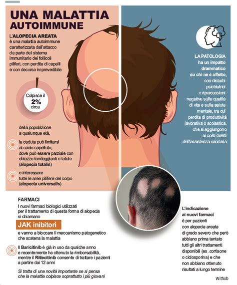 Infografica che confronta l'efficacia di diversi trattamenti per l'alopecia areata (con enfasi sui JAK-inibitori)