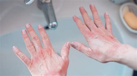 mani irritate da detergenti