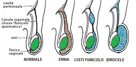 Diagramma di un idrocele testicolare