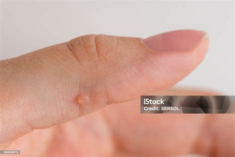 Primo piano di una mano con una verruca trattata con un cerotto