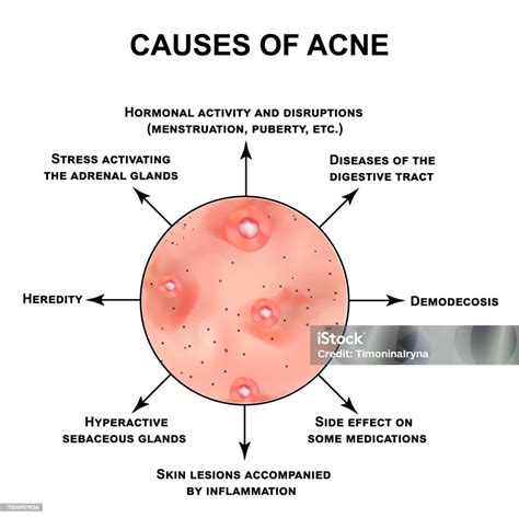 Infografica sulle cause dell'acne