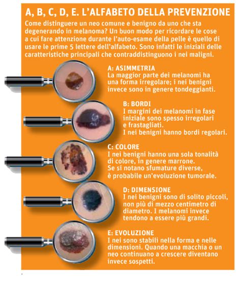 Illustrazione delle diverse tipologie di nei benigni e maligni
