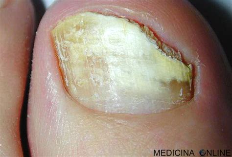 Immagine ravvicinata di un'unghia affetta da onicomicosi