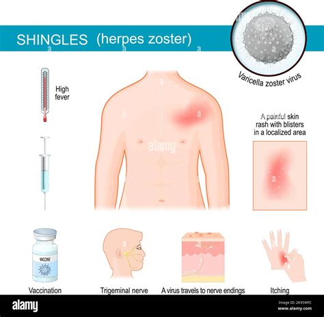 Infografica sulle principali complicanze dell'Herpes Zoster