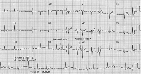 Elettrocardiogramma (ECG) che mostra fibrillazione atriale