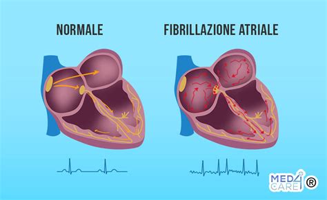 Diagramma che illustra il rischio di ictus nella fibrillazione atriale