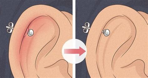 Immagine di un orecchio con un cheloide vicino a un foro per piercing