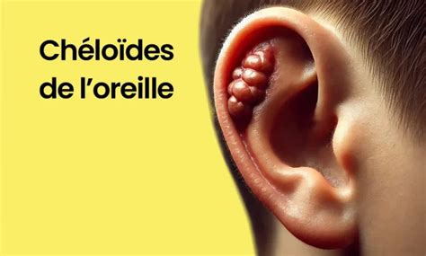 Primo piano di un orecchio con un cheloide ben visibile sul lobo