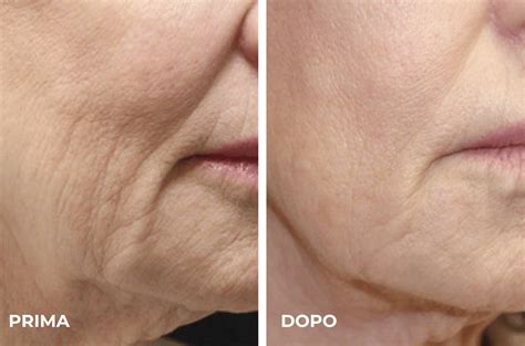 Immagine comparativa: un neo prima e dopo la rimozione laser CO2