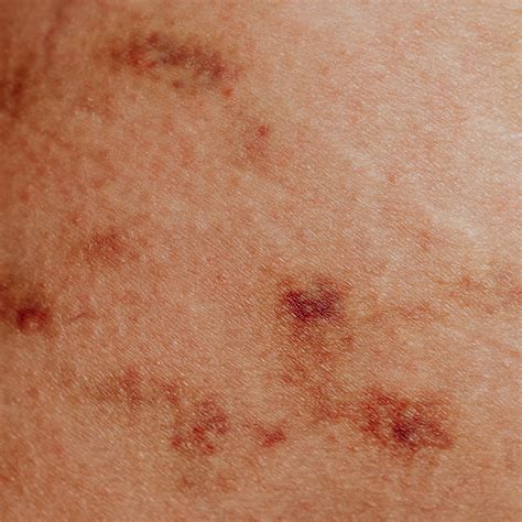 Chiazze eritematose e squamose sulla pelle