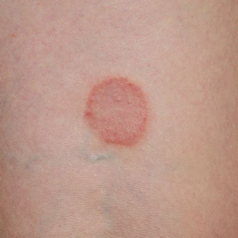 Immagine d'archivio di un'epoca in cui la tigna causava isolamento sociale