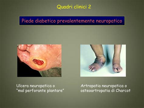 Esempio di ulcera neuropatica (mal perforante plantare) con orletto di ipercheratosi.