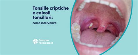 Bambino con placche sulle tonsille