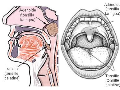 Diagramma di tonsille e adenoidi