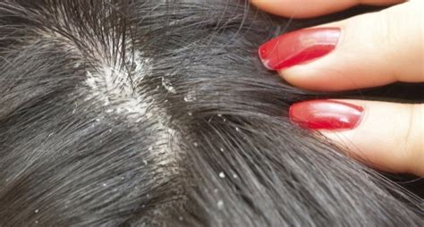 Capelli grassi e forfora